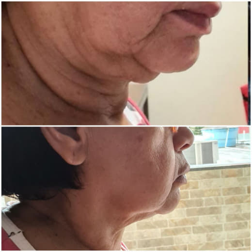 Depoimento antes e depois 4