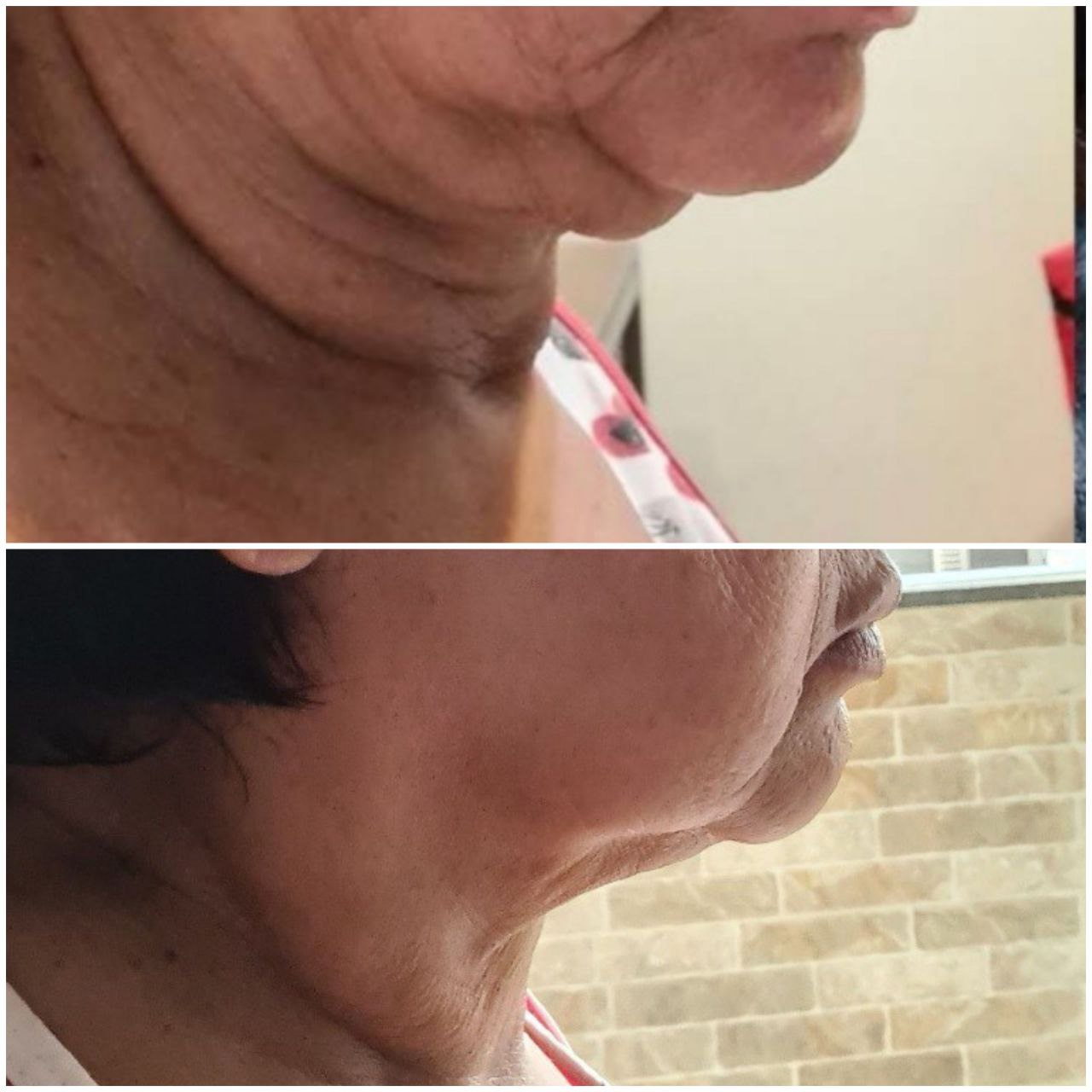 Resultado dramático — antes e depois do pescoço e queixo