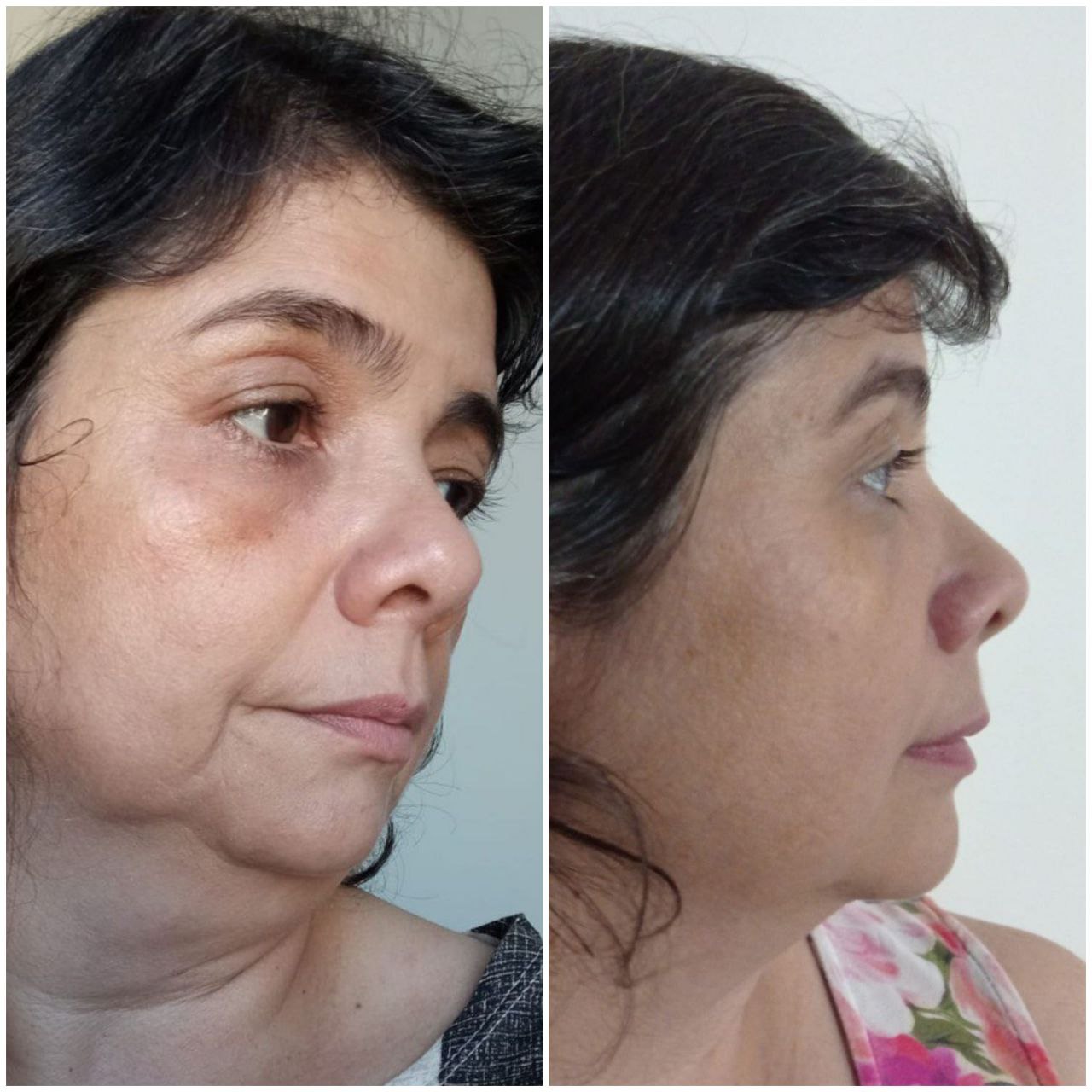 Mulher frustrada com a papada olhando no espelho