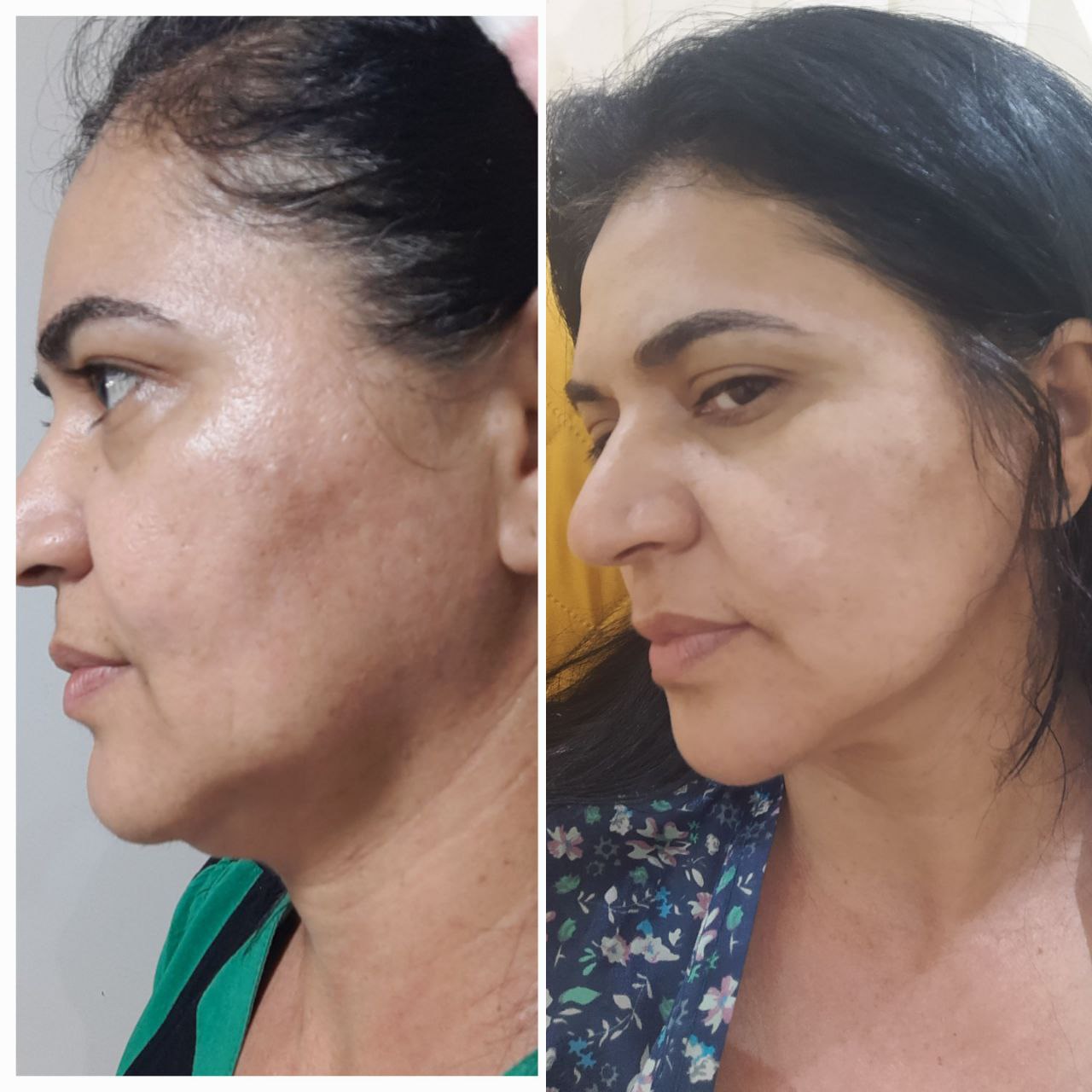 Resultado antes e depois da papada