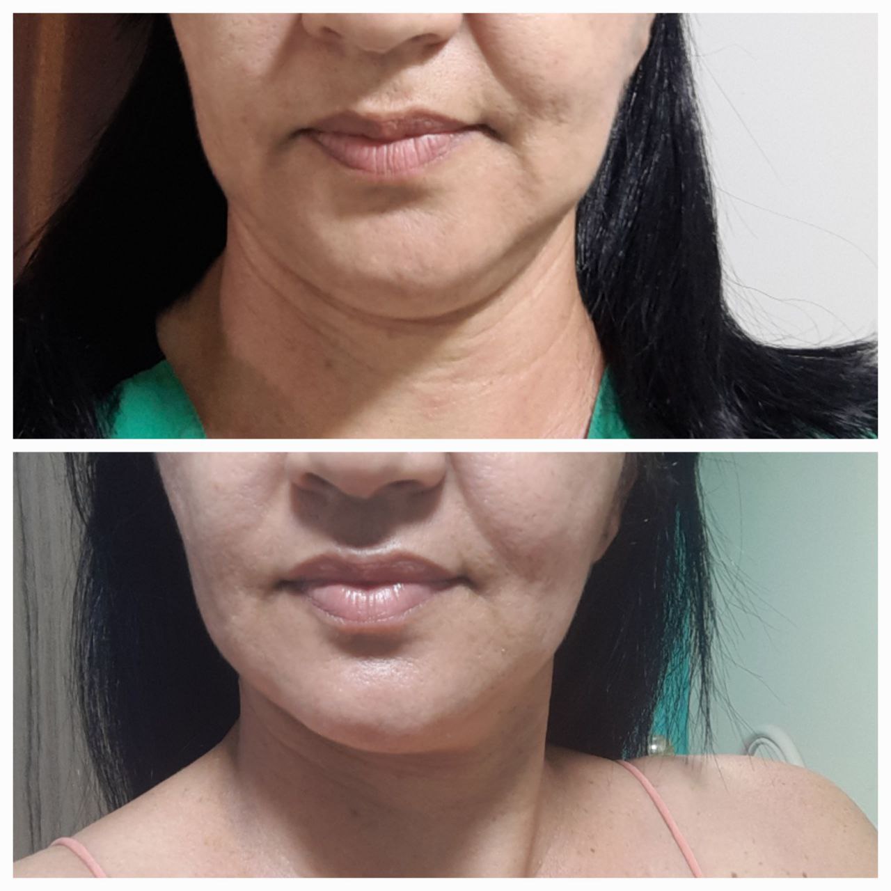 Resultado antes e depois da papada